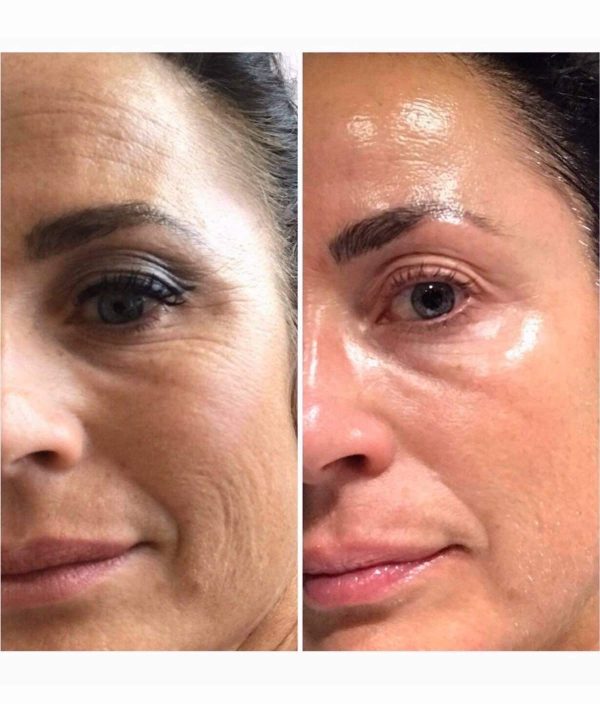 Limpieza facial premium